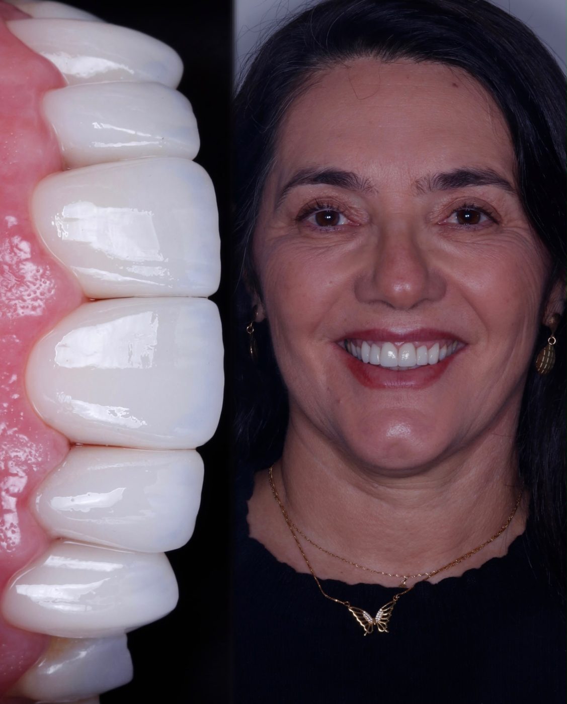 Laminados cerâmicos e sorriso finalizado